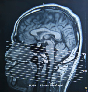 Mri
