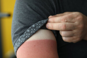 Male hand with a severe sunburn closeup.