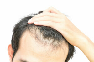 Closeup young man serious hair loss problem