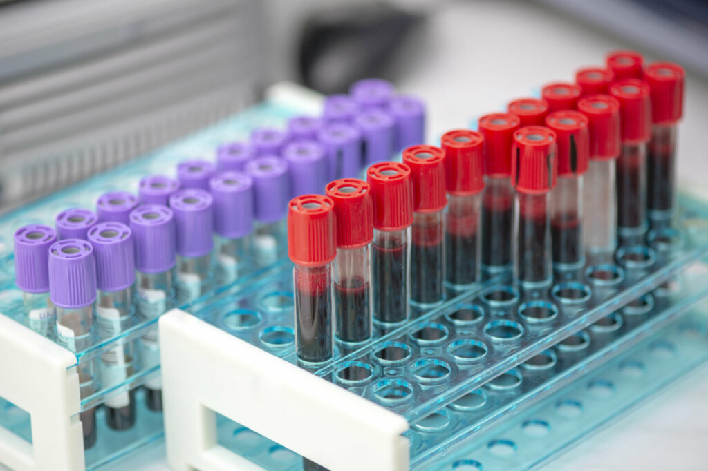 Tubes of blood sample for testing