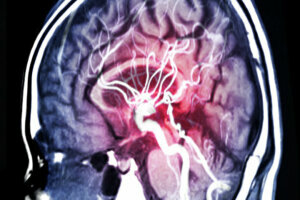 MRA Brain or Magnetic resonance angiography (MRI) of Vessel in the brain sagittal view.