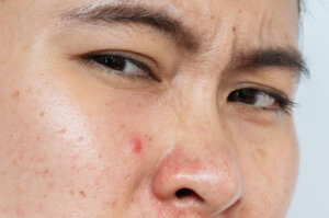 Headshot of acne Inflamed occur on Asian woman skin after wearing a mask for long time during covid 19 pandemic.