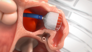 WATCHMAN FLX Product Photography Anatomical