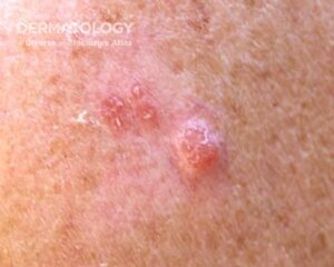 Amelanotic melanoma B