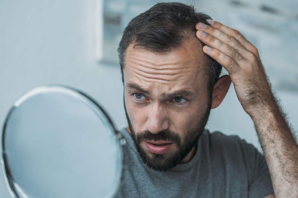 Upset middle aged man with alopecia looking at mirror, hair loss concept