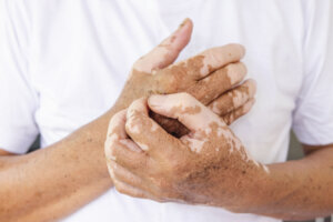 Close up Vitiligo on skin hands of old people. medical condition causing depigmentation of patches of skin