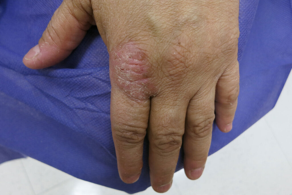 DRY HANDS