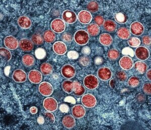 Africa Mpox
