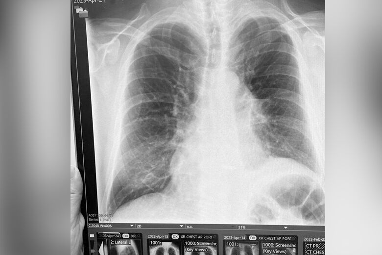 Neal x ray