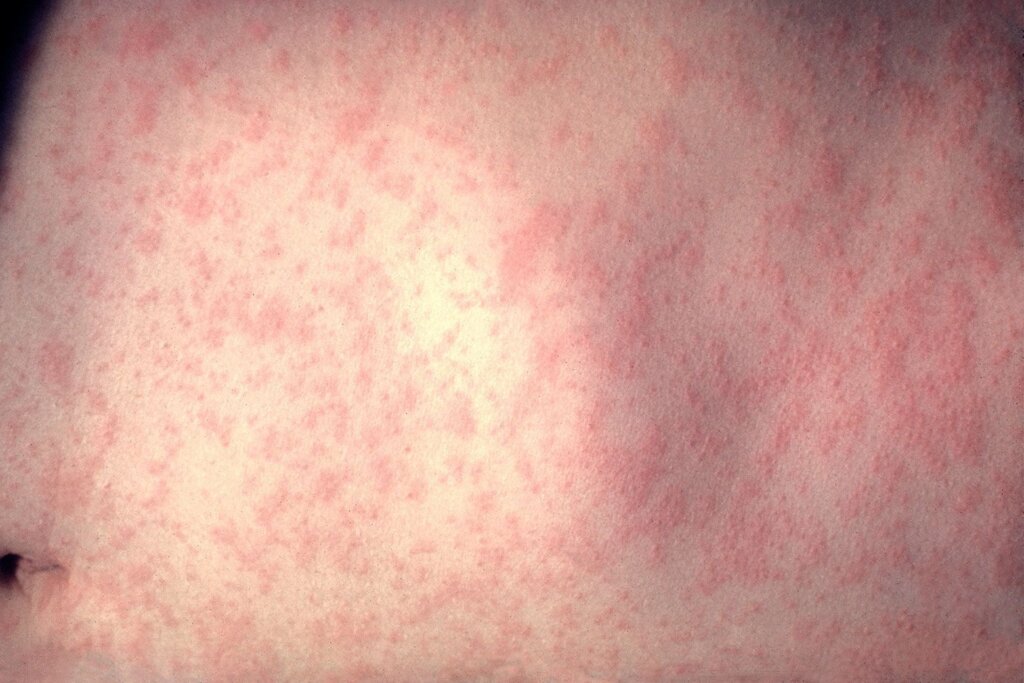 Onset of a measles infection