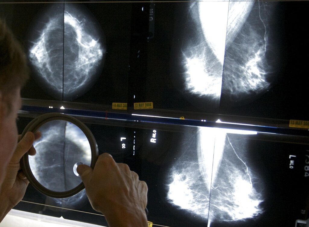 Mammograms Explainer