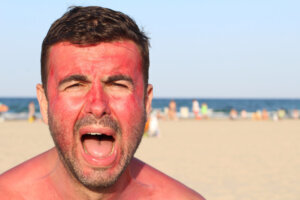 Man overexposing his skin to the sun