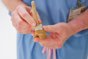 All plastic ankle implant.