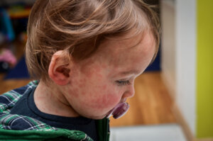 Children viral disease or allergies. Red measles rash on baby.