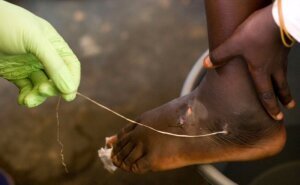 Carter Guinea Worm