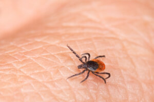 Parasite castor bean, black legged or deer tick on a human skin detail. Ixodes ricinus